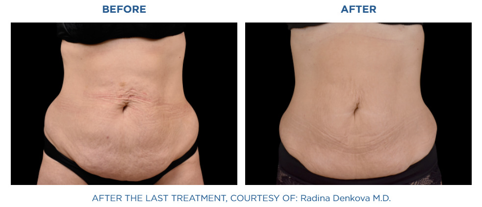 Before and after results 1