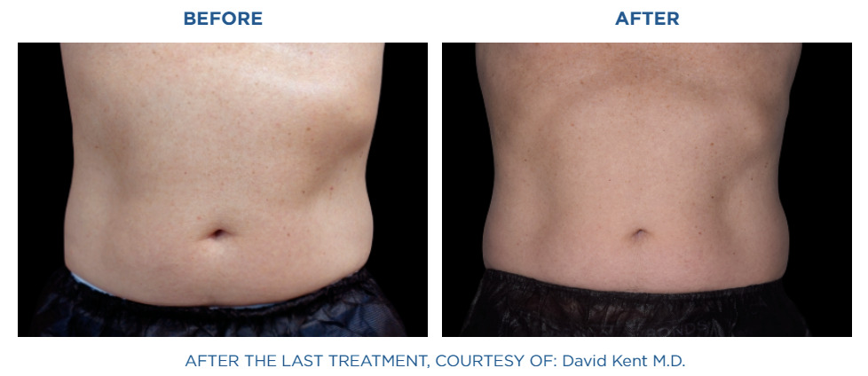 Before and after results 2
