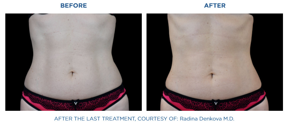 Before and after results 3