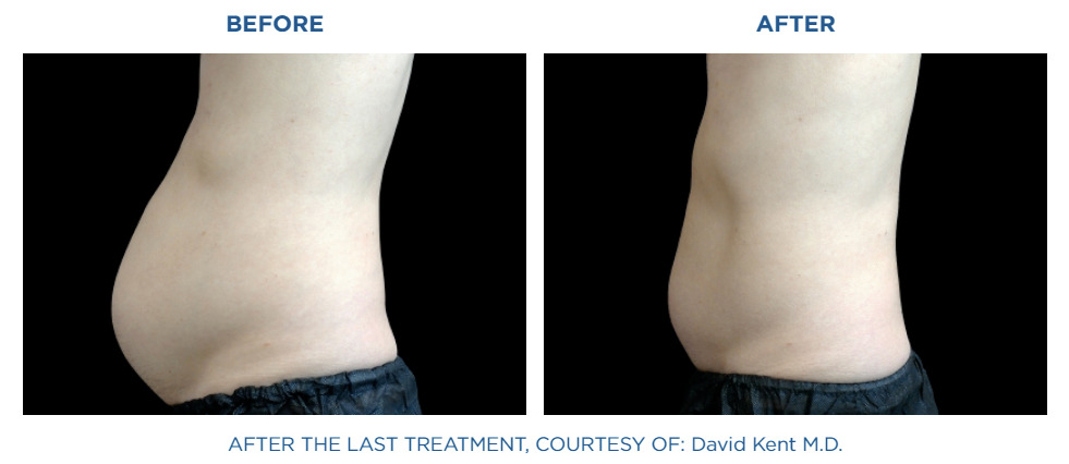 Before and after results 4