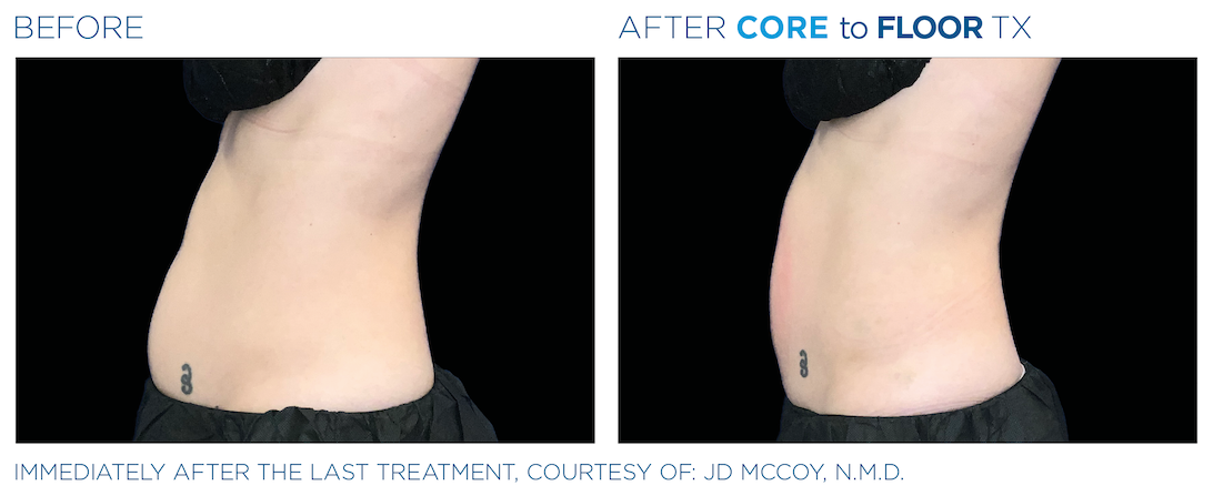 Before and after — Core to Floor treatment, side profile