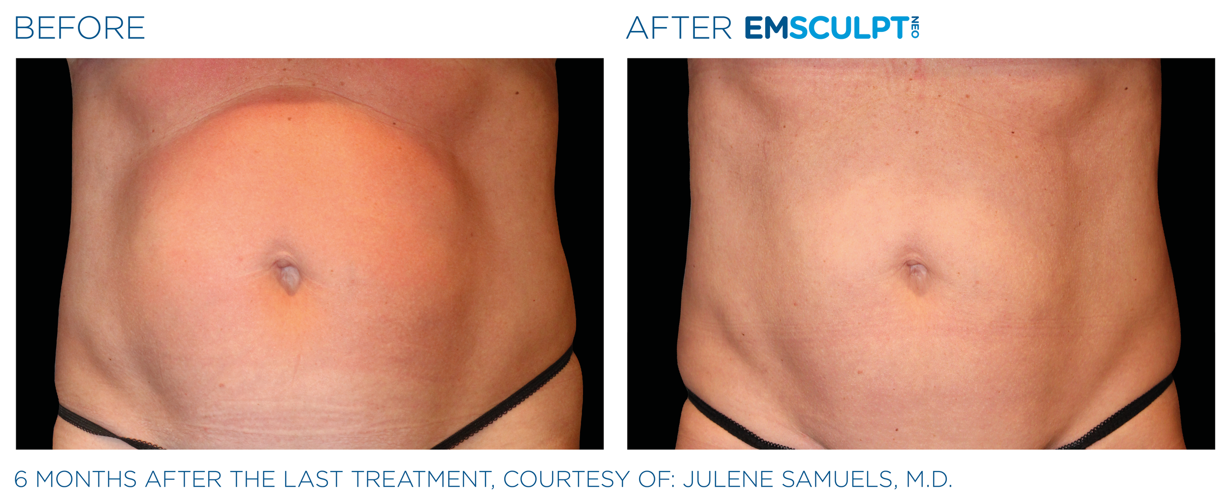 Before and after — EmsculptNEO abdomen, front view