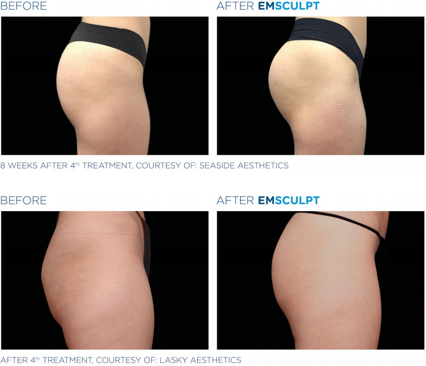 Before and after — Emsculpt buttocks and thighs, two patients